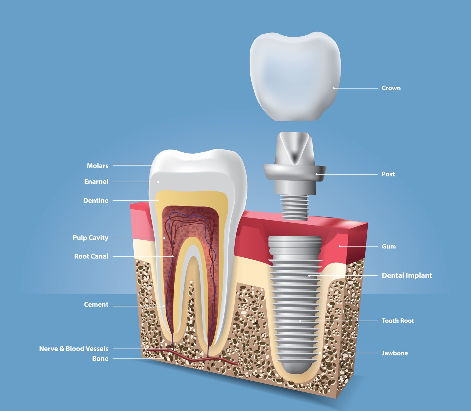 Dental Implants